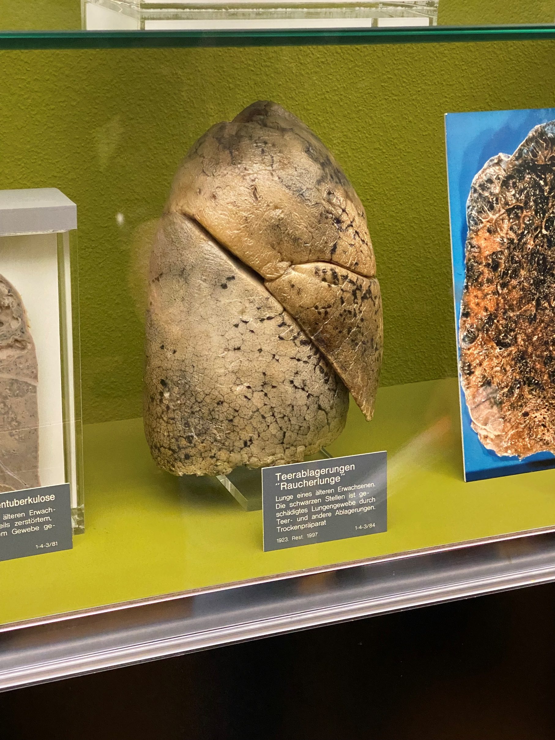 Smoker's lung, Anatomischen Museums, Basel (by Irene Cardiello).jpeg